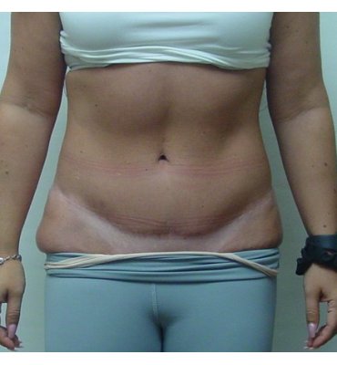 athletic abs from tummy tuck